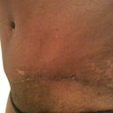Scar @ 4 wks (left side).