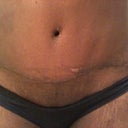Scar @ 4wks (front).  My left hip is larger than the right side.  PS said she will correct it if it does not go down by the 4th or 6th month.  She says I am still pretty swollen.