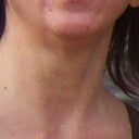 This was my neck 2 months before surgery - Sept 2011