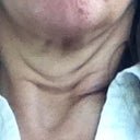 This is my neck now at 8 months post