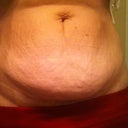 Pre op Pic