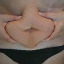 pinching fat in front profile [before]