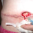 6 week post-op open wound