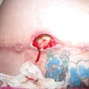 6 week post-op open wound