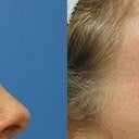PRP Before& After Eyes
