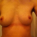Front view: as you can see my right is slightly larger than left. Dr said same size implant will be fine.