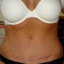 4 Months post op. :)