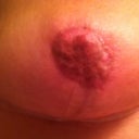Right Nipple. 8 weeks post op. (4 weeks after necrotic tissue removed from areola)