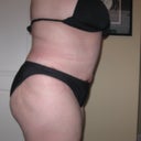 5 week's post-op started smoken again and this is what i get sham on me i know