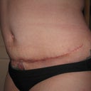 5 week's post-op started smoken again and this is what i get sham on me i know