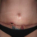 5 week's post-op started smoken again and this is what i get sham on me i know