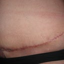 5 week's post-op started smoken again and this is what i get sham on me i know