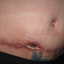 5 week's post-op started smoken again and this is what i get sham on me i know
