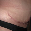 5 week's post-op started smoken again and this is what i get sham on me i know