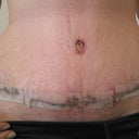 Front view. 2 week post op. Swollen but getting better every day.