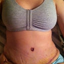 1 week post op