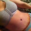 1 week post op