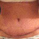2 weeks post op