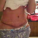 2 weeks post op