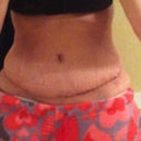 3 weeks post op