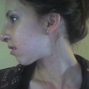 5 days post-op side view
