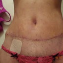 3 weeks pretty good incision and yes dog ears :( Dr will fix  it soon.