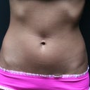 8 weeks post Liposonix