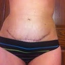 Scar 2 weeks po.  The dark areas along the incision are still a bit of glue that I wasn't brave enough to scrub off.