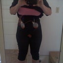 4 days post op frontal view.