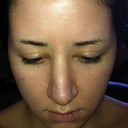 Post op 12 days after Revison Rhino