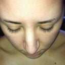 Post op 12 days after Revison Rhino