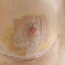 Left with possible haematoma