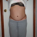 3 weeks post revision on the right side (front view)