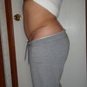 3 weeks post revision on the right side (left view)