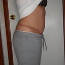 3 weeks post revision on the right side (right view)