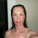 14 days post op