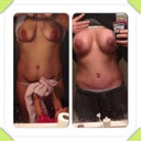 Pre op and almost 6 weeks