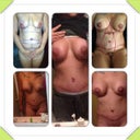 Preop, day 1 post op, 2 weeks, 3/4 weeks and almost 6 weeks in the middle.