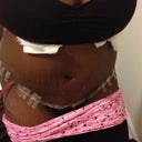 Close-up standing- Day 3 post op- Notice I have only one drain. Thankfully it is not coming out of my Vee Jay!