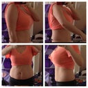 7 days pre-op. chubby arms and especially chunky mid section. Getting cellulite which was never a problem for me before gaining weight.