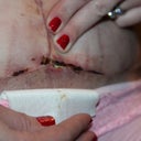PO day 19 - white cream cheese looking stuff in incision. :(