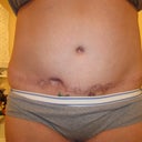 8 month's post pot as you can see my open wound has closed up and healed and in 2 months i get to go in for my SRS woo hoo