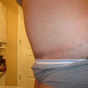 8 month's post pot as you can see my open wound has closed up and healed and in 2 months i get to go in for my SRS woo hoo