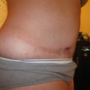 8 month's post pot as you can see my open wound has closed up and healed and in 2 months i get to go in for my SRS woo hoo
