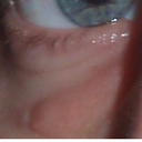 under eye lump