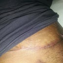 incision, can you see the ugly vertical scar