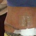 5 days out ~ panties are pulle ddown low so it makes the scar look high but actually its very low..thank god !