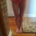 BEFORE Zerona: my thighs never change no matter what my weight!