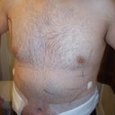 After -front (1 day post-op)