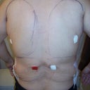After -back (1 day post-op)
